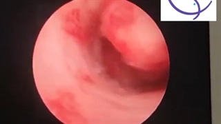 فیل واقعی بررسی حفره رحم با دوربین (هیستروسکوپی)