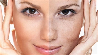لک های پوستی را جدی بگیرید تزریق چربی