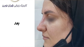 فیلم اصلاح فرم بینی بدون جراحی