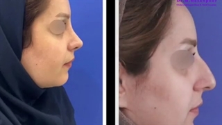 نتیجه عالی از جراحی بینی