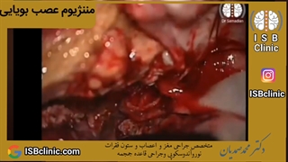 مننژیوم عصب بویایی