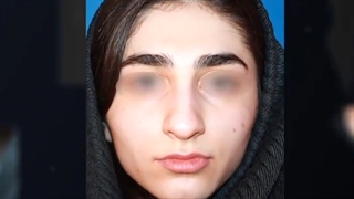 نتیجه عمل بینی استخوانی