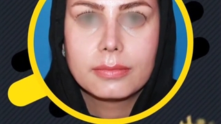 جراحی بینی گوشتی