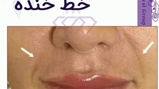 تزریق فیلر خط خنده