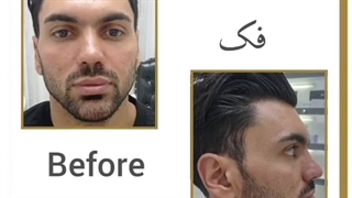زاویه سازی فک آقا