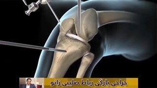 جراحی رباط صلیبی زانو
