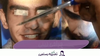 جراحی بینی توسط دکتر نصیبه رستمی