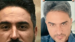 تزریق ژل و بوتاکس