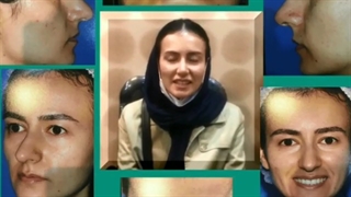 تغییرات بینی یکی از بیماران بعد از سه ماه