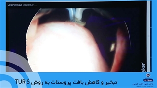 تبخیر و کاهش بافت پروستات به روش TURIS