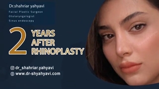 دو سال بعد از جراحی بینی | دکتر یحیوی