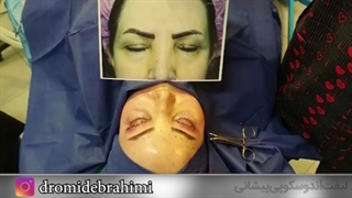 لیفت آندوسکوپی پیشانی