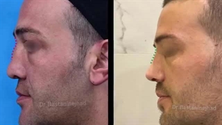 40روز بعد از جراحی بینی با سابقه ضربه | دکتر باستانی نژاد | جراح بینی