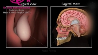 فیلم واقعی جراحی پولیپ بینی