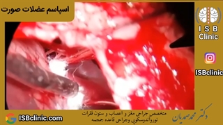 اسپاسم عضلات صورت