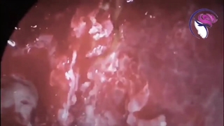 فیلم جراحی آندوسکوپی سینوس