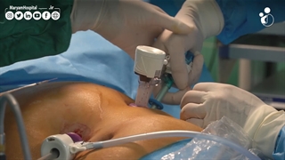 عمل اسلیو معده در اتاق عمل