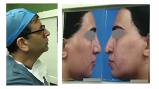 فیلم عمل قوز بینی و افتادگی نوک بینی