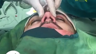 فیلم واقعی جراحی بینی و بهبود راه تنفس