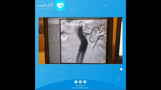 ترمیم آنوریسم آئورت با اندوواسکولار