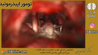 تومور اپیدرموئید