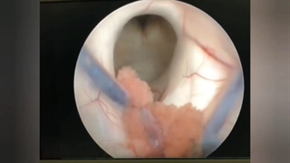 عمل جراحی ونتریکولوستومی آندوسکوپیک بطن سوم(ETV) جهت درمان هیدروسفالی