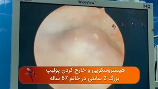 جراحی هیستروسکوپی