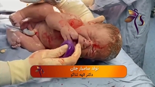 زایمان سزارین