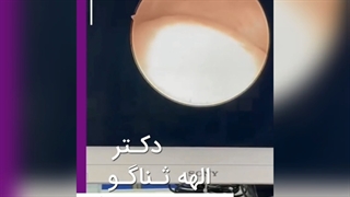 جراحی پولیپ بزرگ سه سانتی