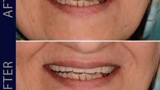 نمونه ایمپنت های انجام شده