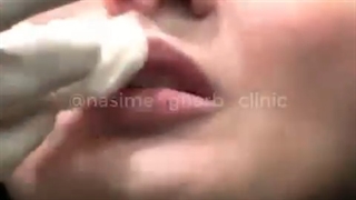 فرم دهی لبا با تزریق ژل