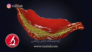 بیماری سلول داسی شکل ، SCD ، کمخونی داسی
