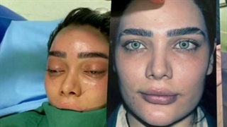 فیلم لیفت آندوسکوپی ابرو و شقیقه در خانم ۳۱ ساله