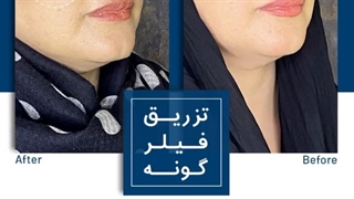 فیلر گونه عصب‌کشی
