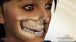 انواع روش های جراحی برای درمان ناهنجاری کلاس III | دکتر سپیده دادگر