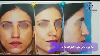 فیلم واقعی جراحی بینی با انحراف شدید