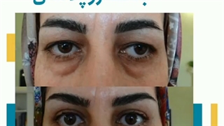 بلفاروپلاستی
