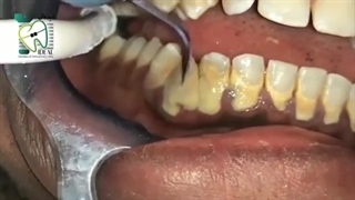 توصیه می شود شش ماه یک بار، دندان هایتان را جرم گیری کنید | کلینیک ایده آل
