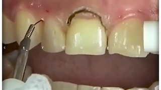 لیفت لثه | کلینیک دندانپزشکی ایده آل