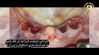 فیلم واقعی ایمپلنت ۵ دندان فک پایین همراه با بازسازی استخوان