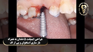 فیلم واقعی ایمپلنت 5 دندان و باز سازی استخوان و PRF