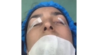 فیلم واقعی جراحی بینی کج