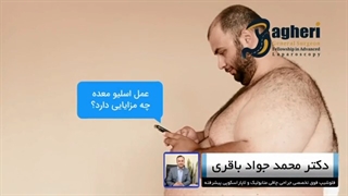 مزایا عمل اسلیو معده