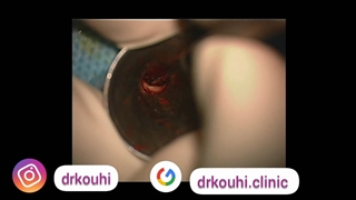 اتواسکلروز