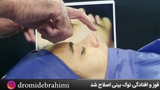 فیلم عمل بینی گوشتی | دکتر ابراهیمی
