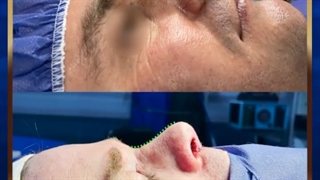 جراحی زیبایی بینی | دکتر طاهریان