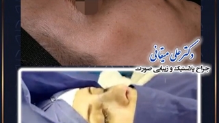 بلافاصله بعد از جراحی بینی | دکتر میقانی
