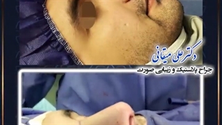 جراحی آندوسکوپیک بینی | دکتر میقانی