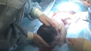 موضوع : فیلم جراحی زایمان  سزارین ( خانم دکتر محبوب ماموریان اصفهانی )