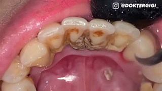 جرمگیری دندان مشهد